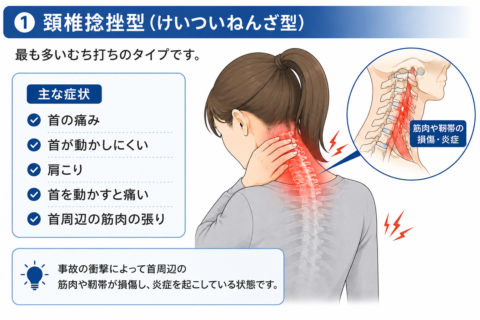 交通事故による頸椎捻挫型のむち打ち症を説明した画像